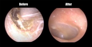 Ear Wax Removal Before and After Treatment at Holistic Audiology
